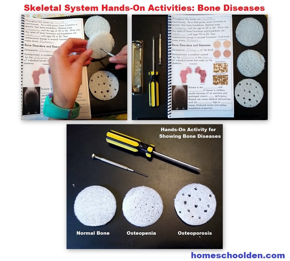 Skeletal System Hands-On Activities Bone Diseases